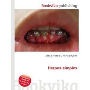  Herpes simplex Ronald Cohn Jesse Russell Books